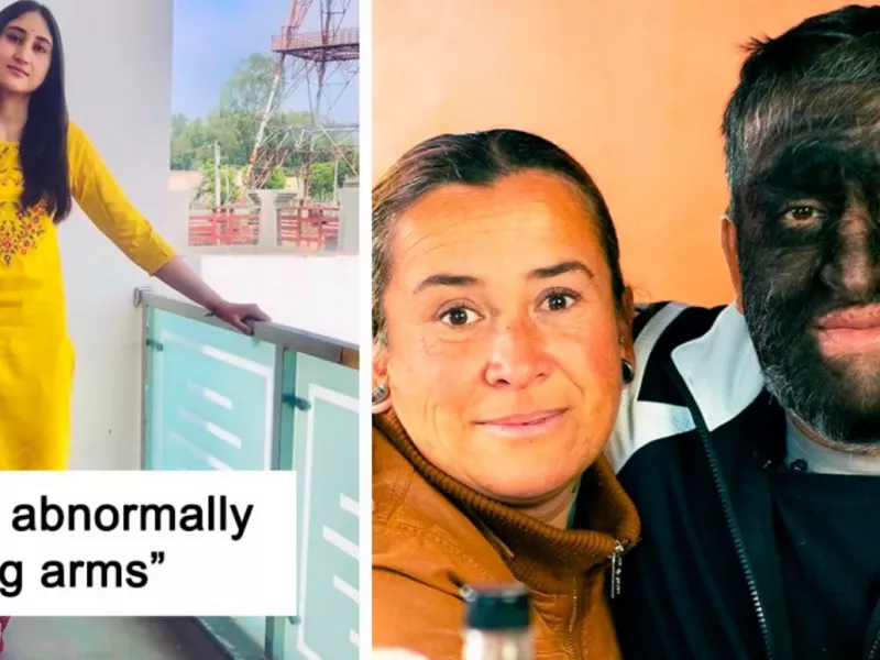 20 انسان عجیبی که در اثر اختلالات ژنتیکی متولد شدند !