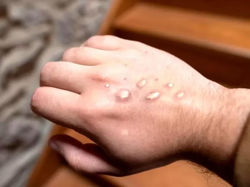 هراس جهان از اپیدمی جدید / ویروس ام پاکس قربانی گرفت!!