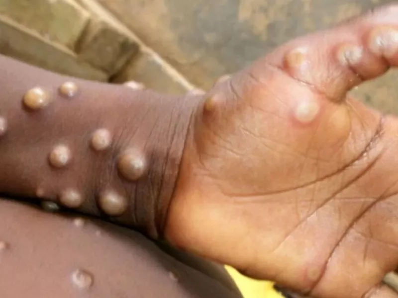 میران کشندگی آبله میمونی چند درصد است ؟