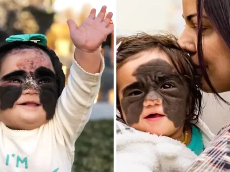 دختر کوچولویی که به خاطر چهره «بتمن»اش «هیولا» نامیده شده بود،حالا شبیه یک شاهزاده خانم دیزنی است!