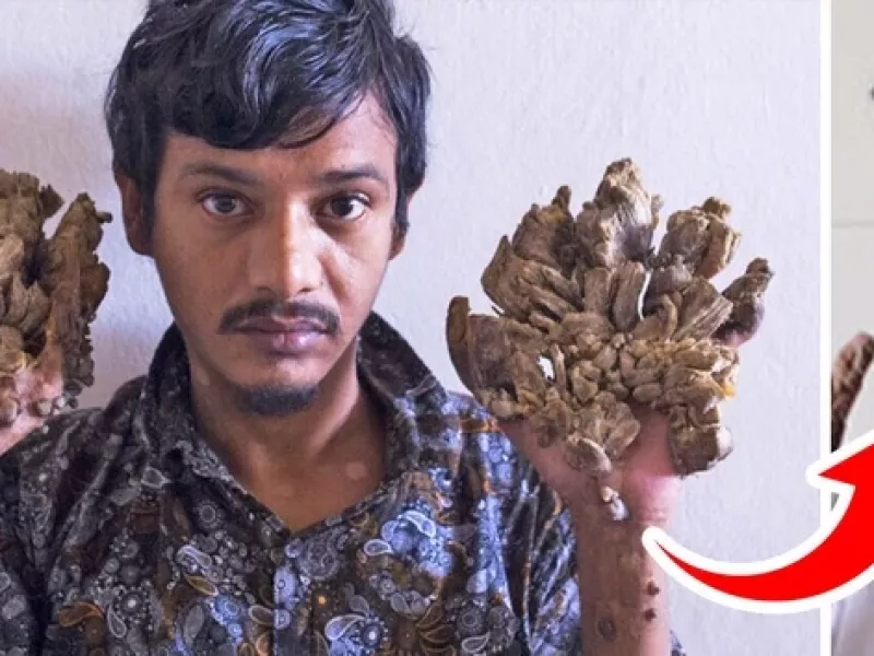 «مرد درختی» پس از جراحی های فراوان توانست دوباره دخترش را در آغوش بگیرد!