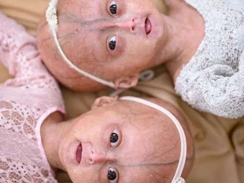 با دوقلوهای مبتلا به سندرم نادر بنجامین باتن آشنا شوید !